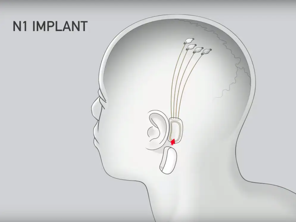 TRIỂN VỌNG THỬ NGHIỆM CẤY CHIP CỦA CÔNG TY NEURALINK - Ảnh 2.